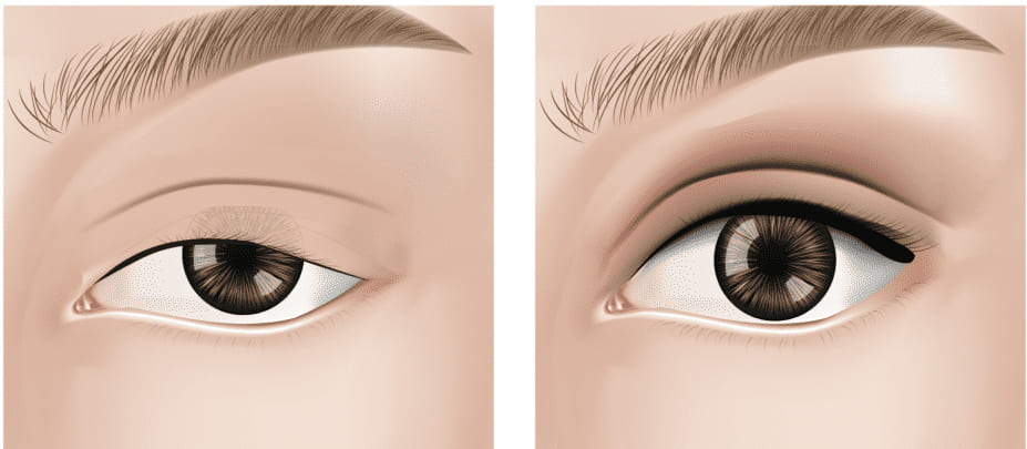 안검하수에 의한 눈꺼풀 처짐 증상 비교