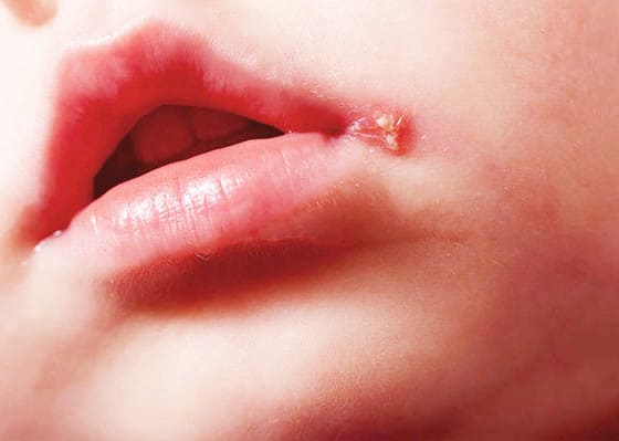 입술 헤르페스 연고 및 전염성