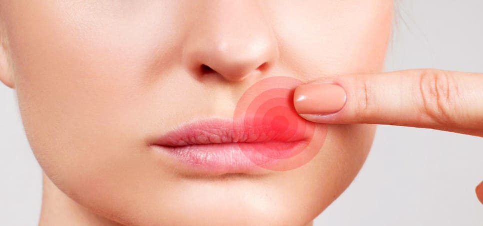 입술 포진 초기증상