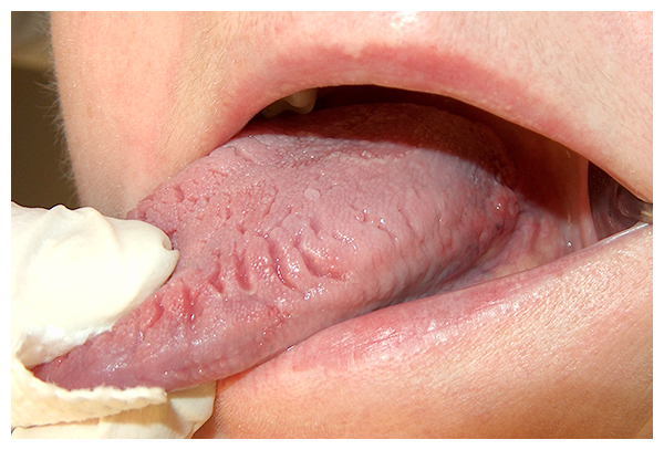 혀 갈라짐 혓바닥 통증을 일이키는 관련 질환