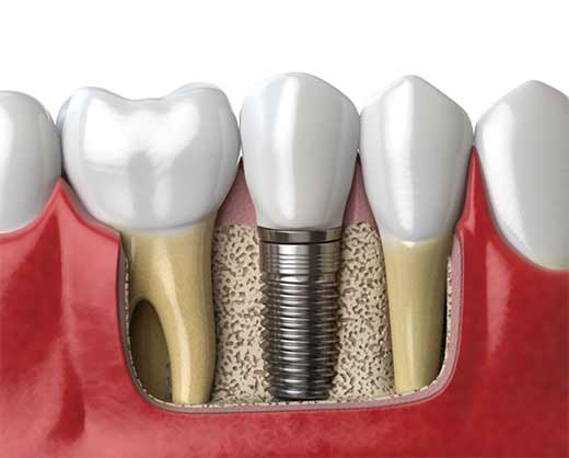 Dental implant procedure steps